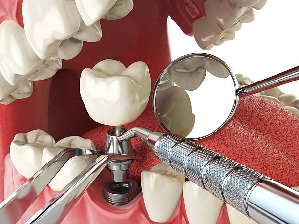 Best Emergency Tooth Extraction  in Deridder, LA